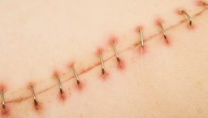 Các loại mũi khâu y tế - phẫu thuật thẩm mỹ (mũi khâu rời)