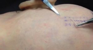 Lợi ích của chỉ khâu vết thương